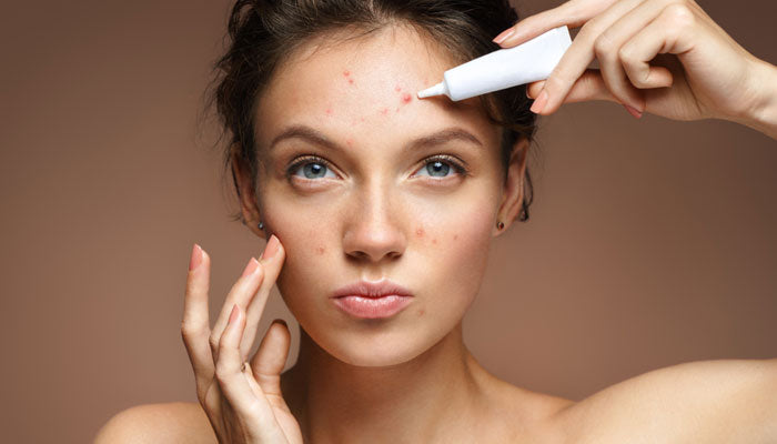 5 Common Skincare Mistakes that Could Be Causing Your Acne