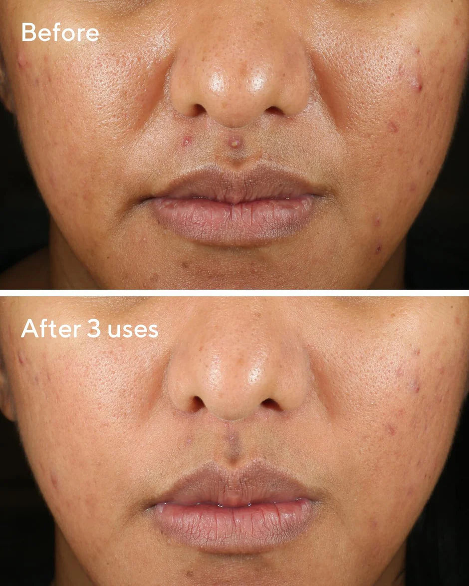 Murad Rapid Relief Acne Sulfur Mask