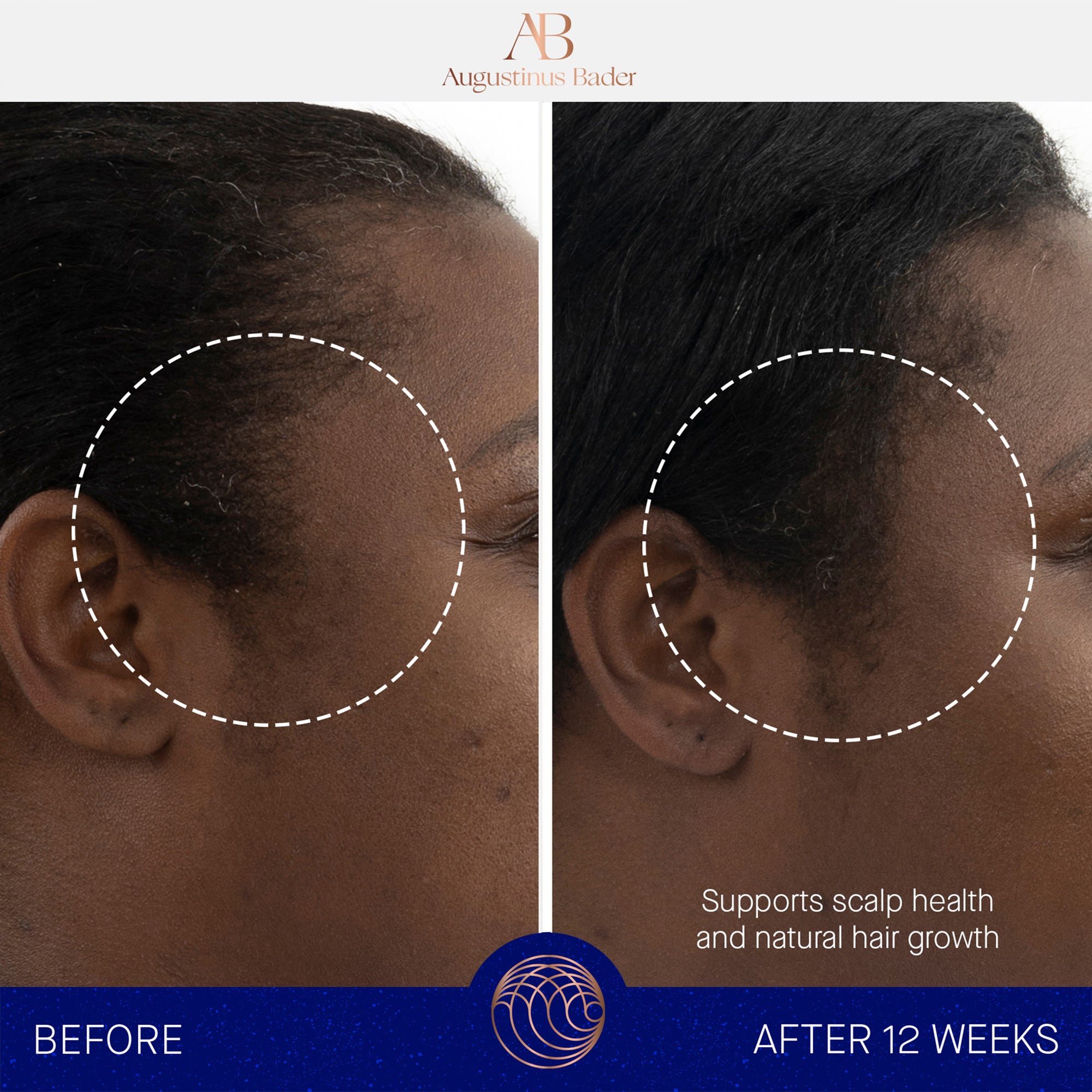 Augustinus Bader The Scalp Treatment