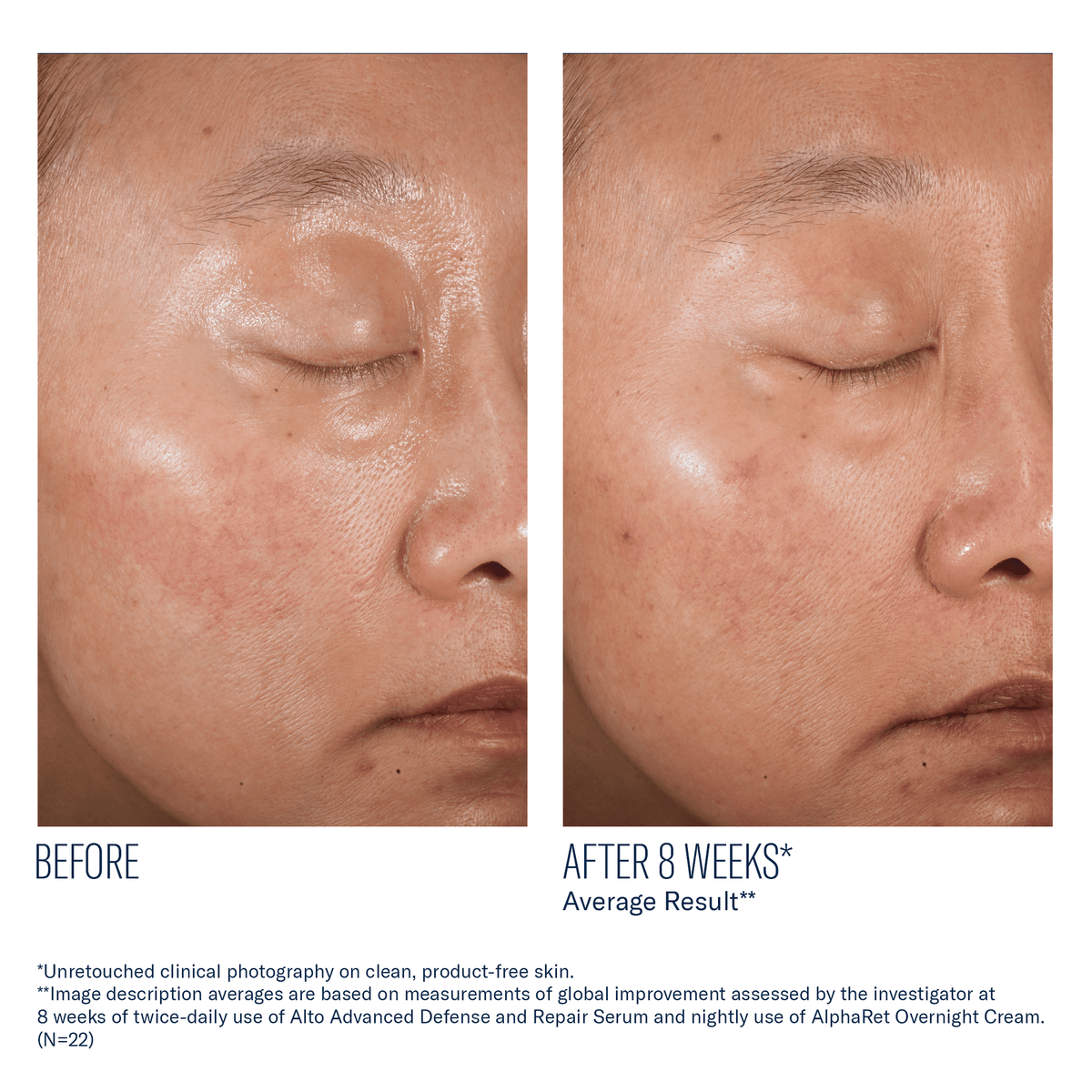 Before and after 8 weeks skin comparison with skinbetter A-Team Duo, showing improved facial texture and tone