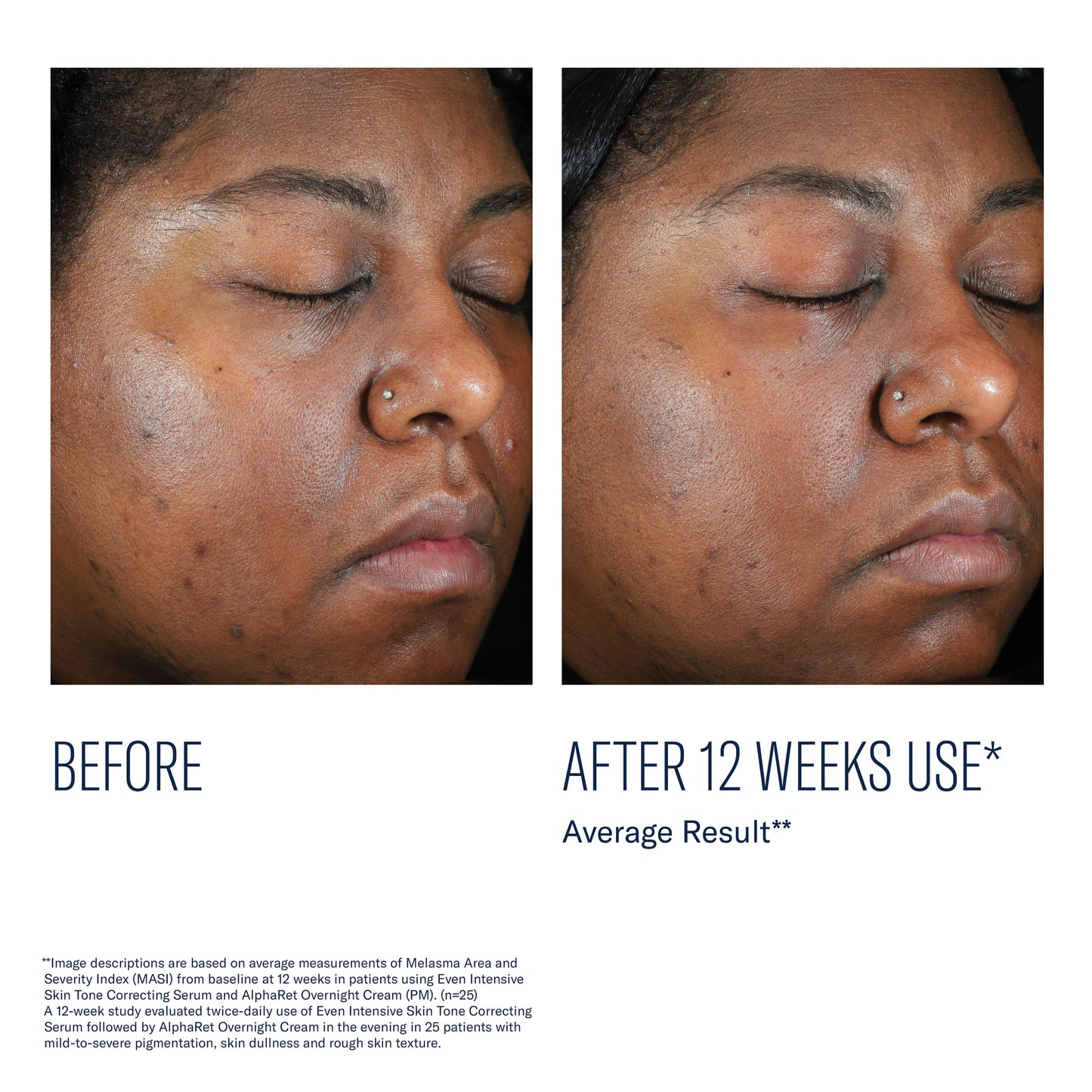 skinbetter Even Intensive Skin Tone Correcting Serum