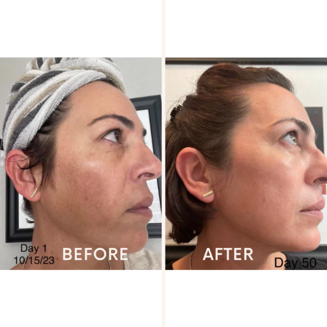 Skincare Junkie Discoloration Fade Wand