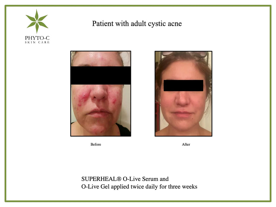 Phyto-C Superheal O-Live Serum