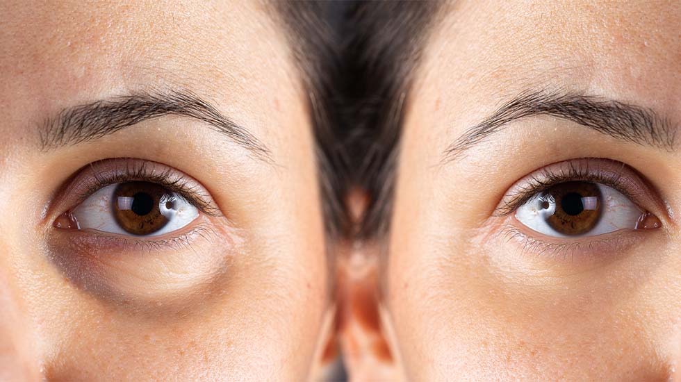 Puffy Eyes In The Morning: Causes & Solutions