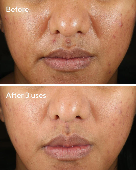 Murad Rapid Relief Acne Sulfur Mask