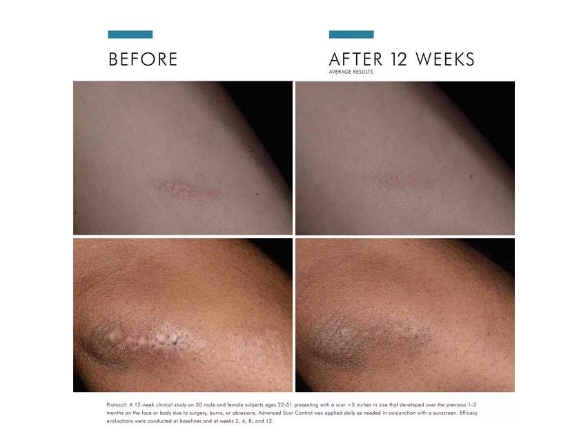 SkinCeuticals Advanced Scar Control