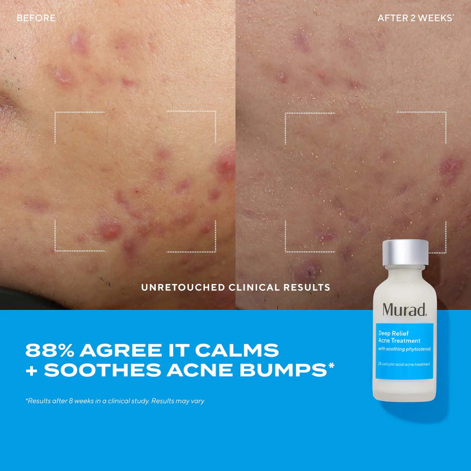 Murad Deep Relief Acne Treatment