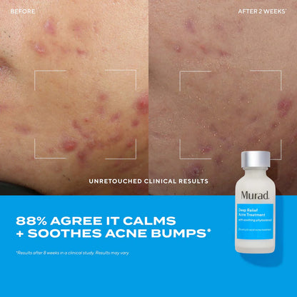 Murad Deep Relief Acne Treatment