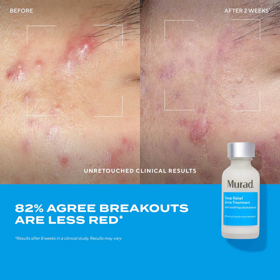 Murad Deep Relief Acne Treatment