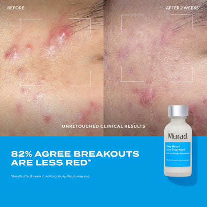 Murad Deep Relief Acne Treatment