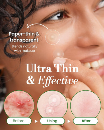Troubless Invisible Pimple Spot Patch - The Classic