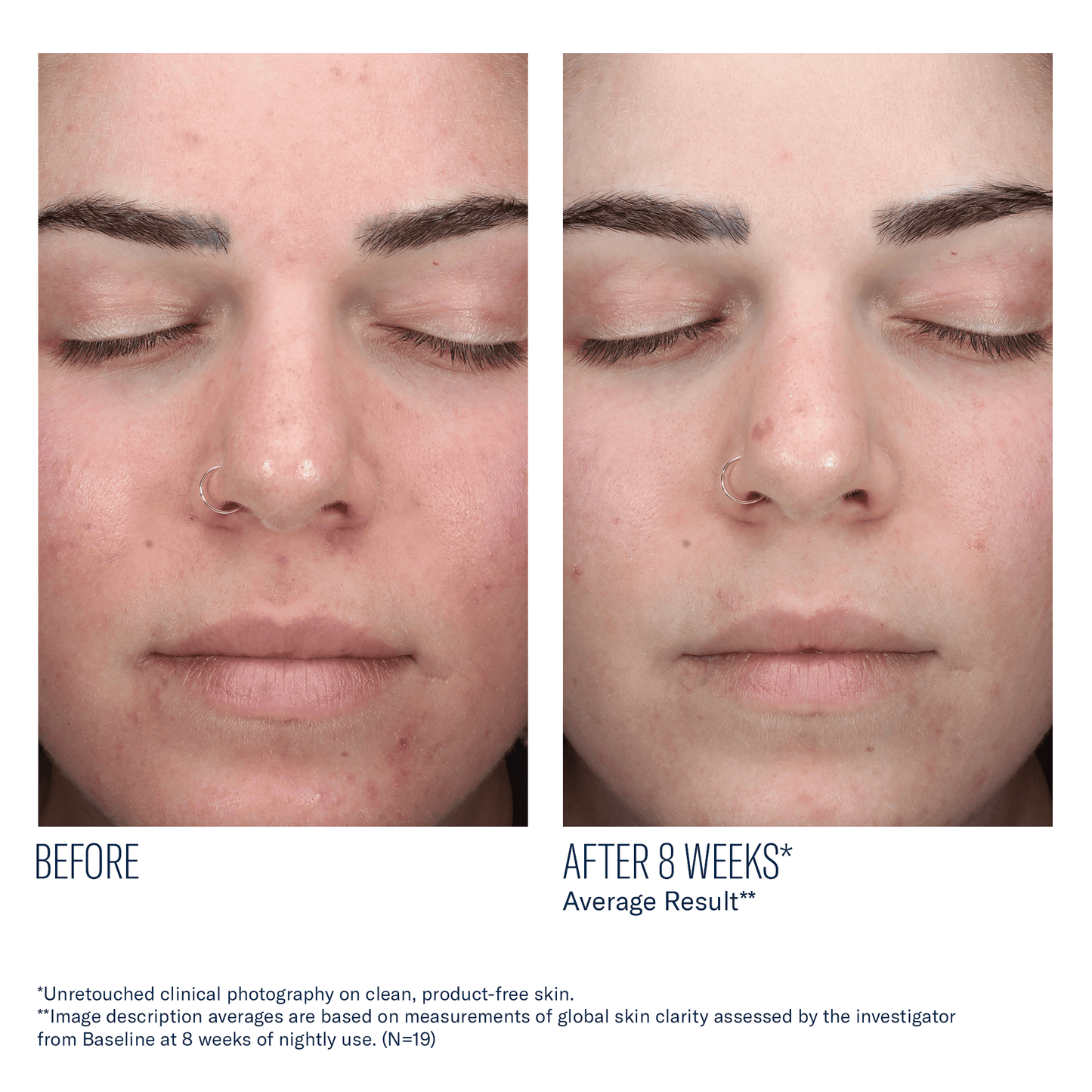 skinbetter AlphaRet Clearing Serum