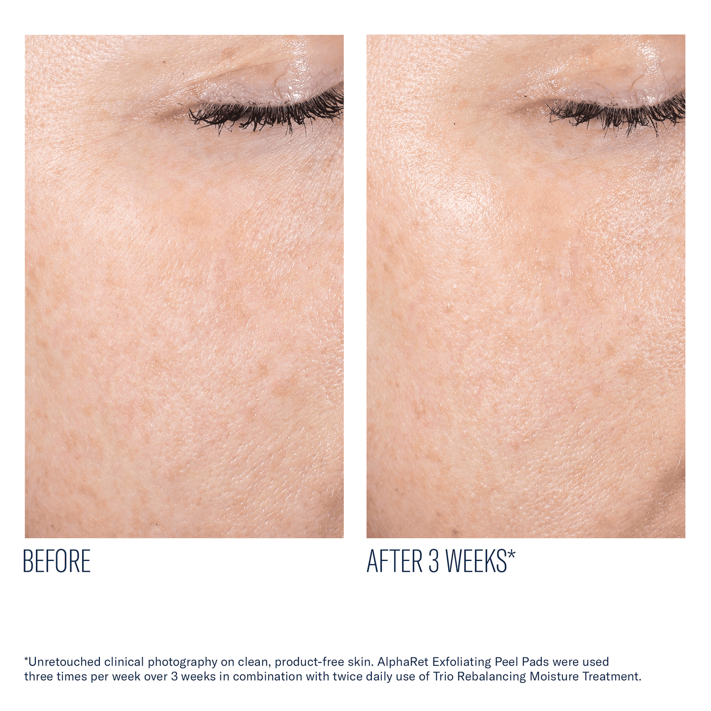 skinbetter AlphaRet Exfoliating Peel Pads