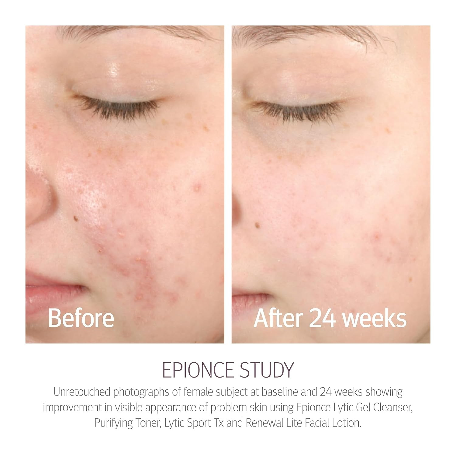 Epionce Lytic Gel Cleanser