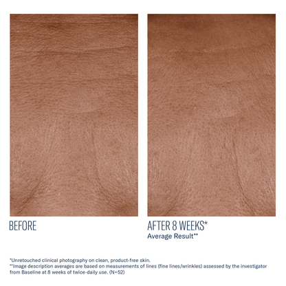 InterFuseFACE_NECK_BeforeAfter_Rev2545