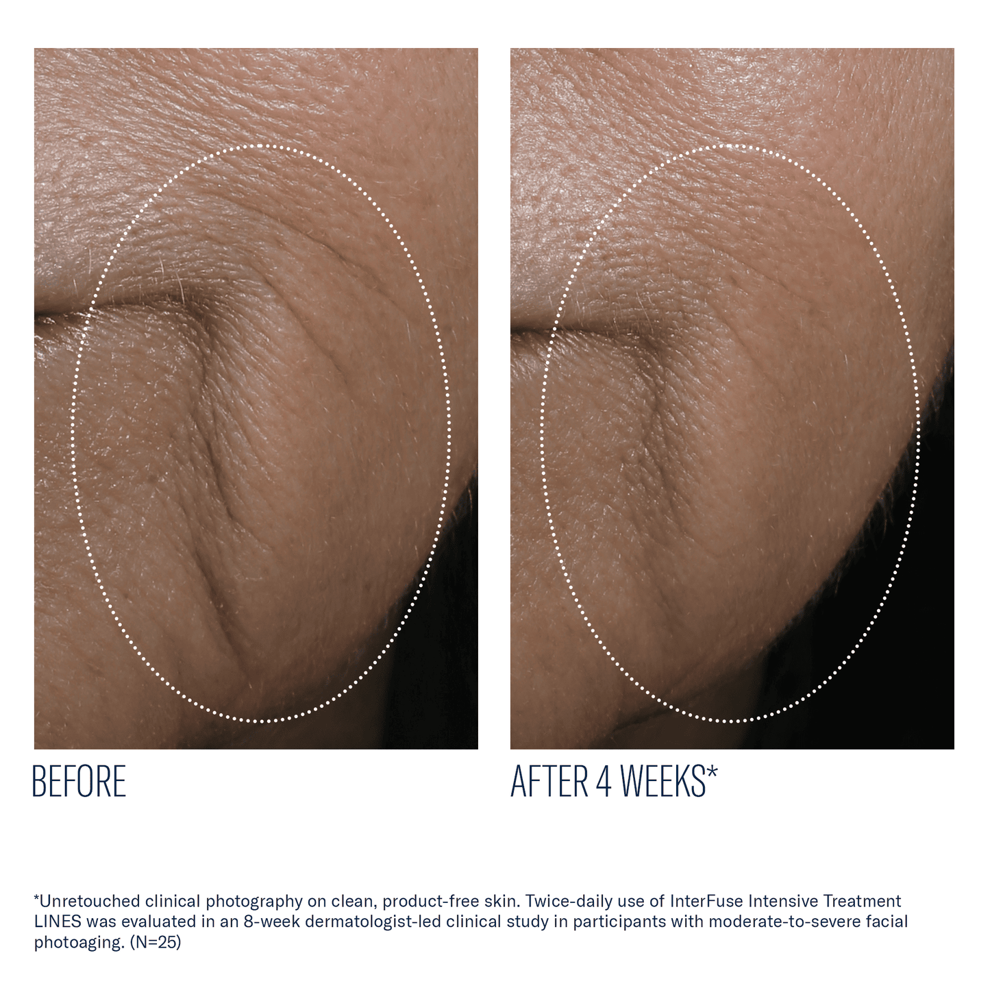 skinbetter InterFuse Intensive Treatment LINES