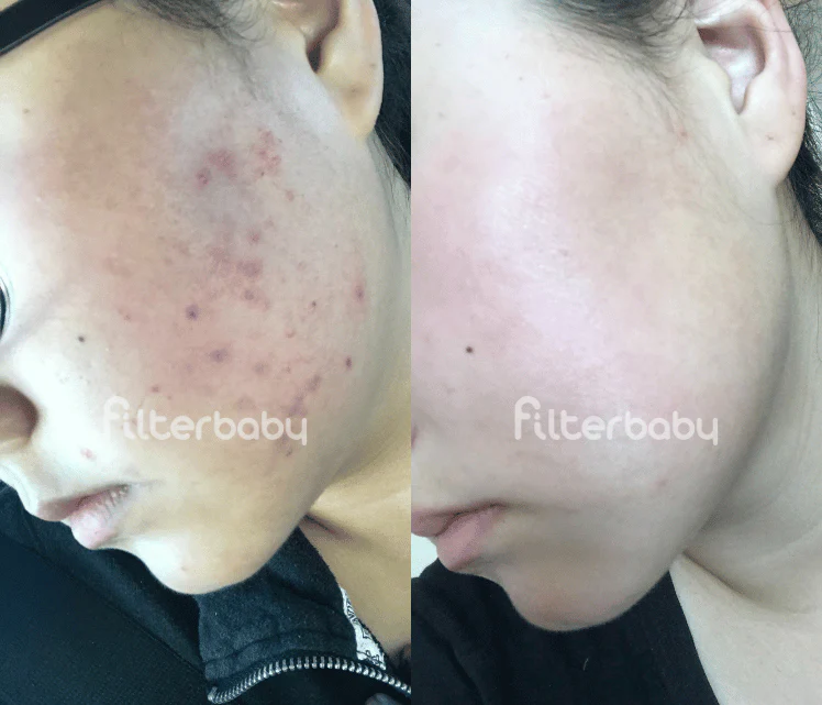 Filterbaby Skincare Filter Replacement 2.0