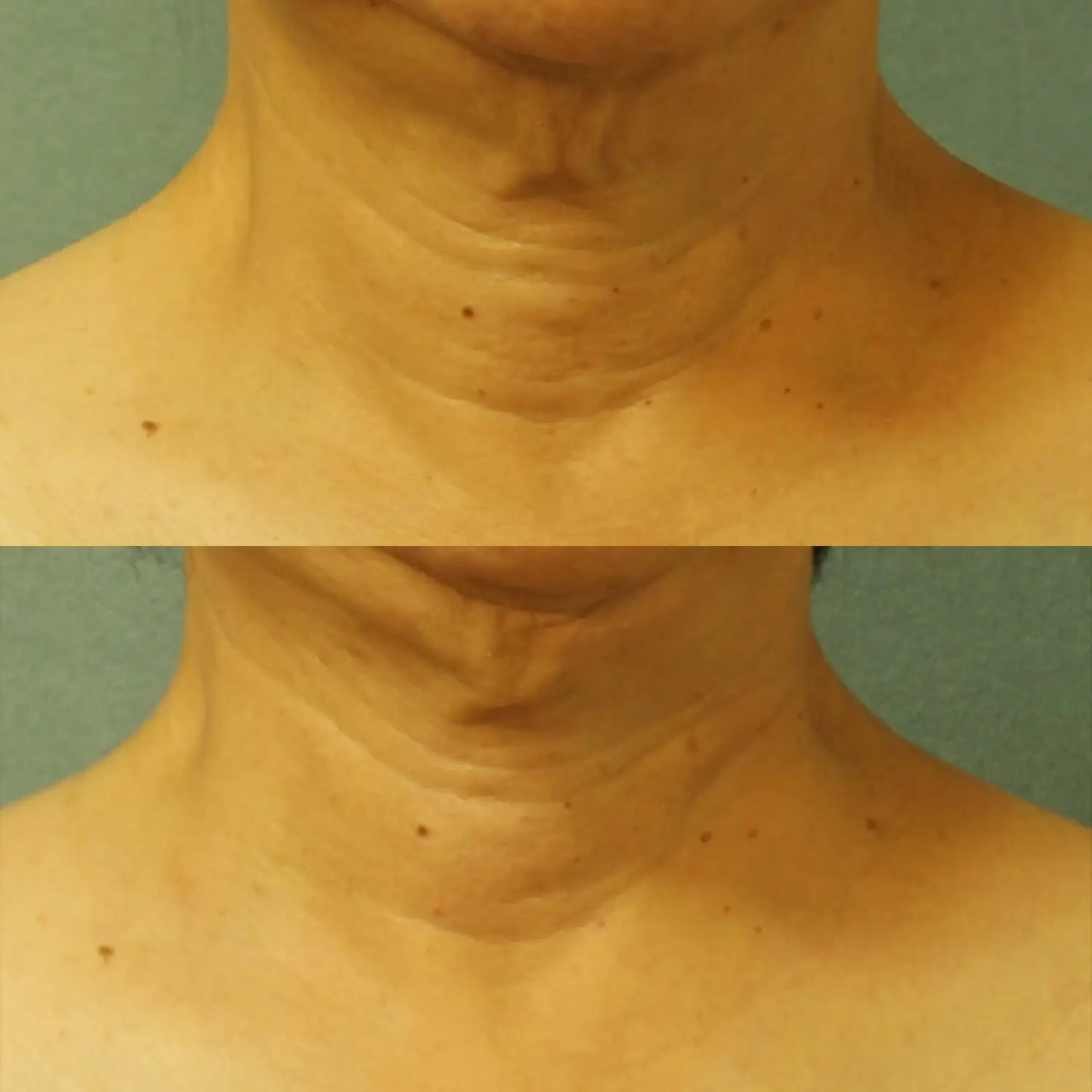 Perricone MD Cold Plasma Plus Neck Chest SPF 25