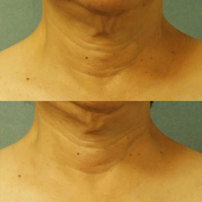 Perricone MD Cold Plasma Plus Neck Chest SPF 25